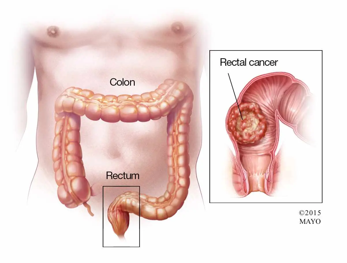 Anal Cancer Treatment