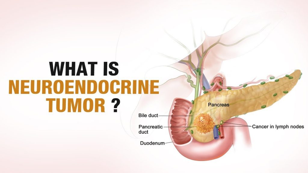 Neuroendocrine Tumor Treatment