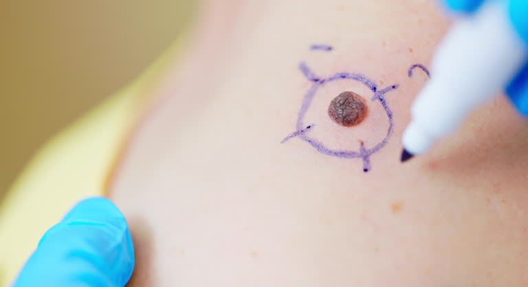 Melanoma Treatment