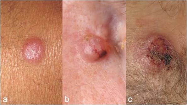 Merkel Cell Carcinoma Treatment