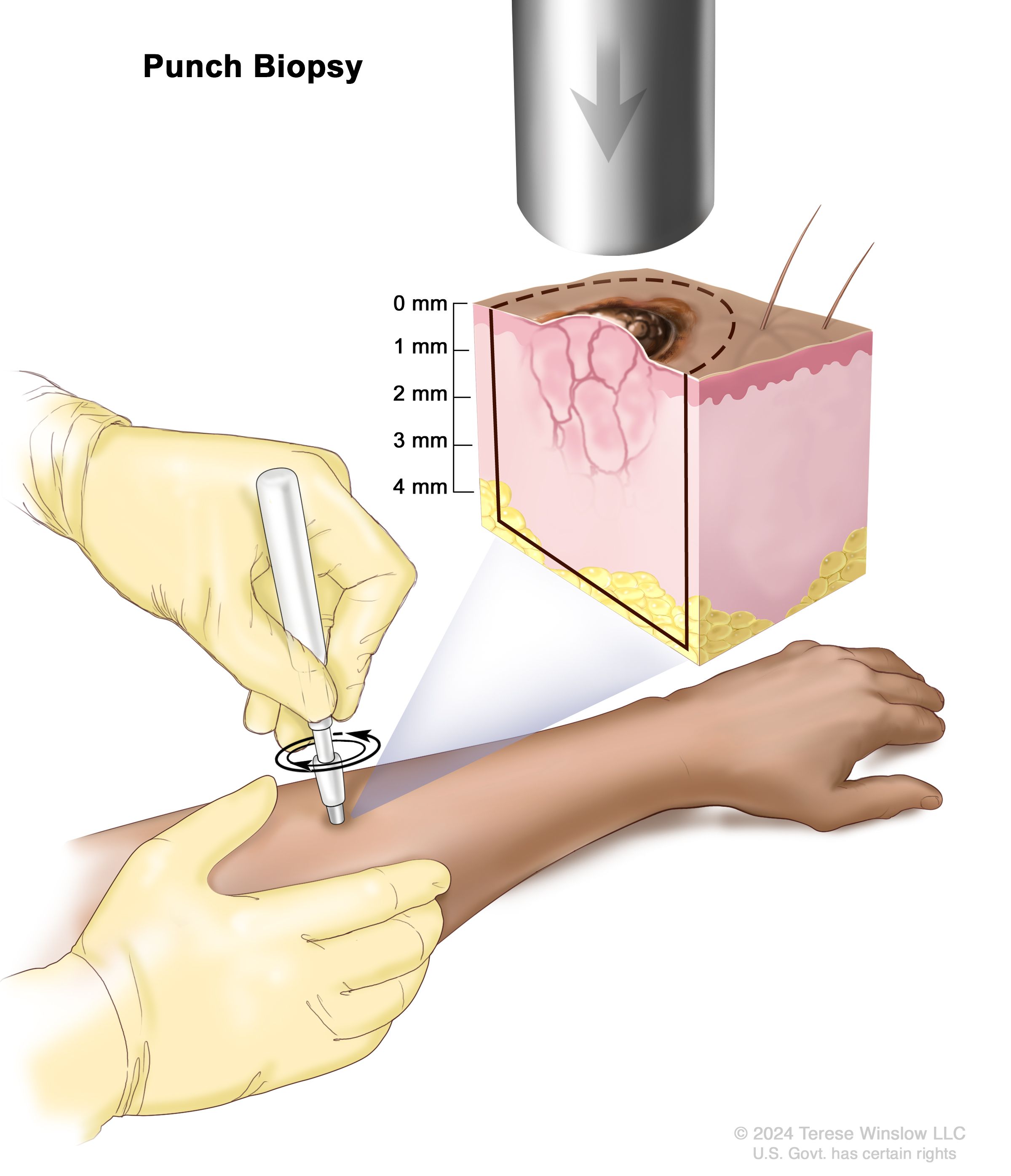 Skin Cancer Treatment
