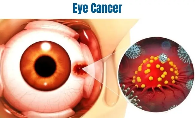 Eye Tumor Treatment