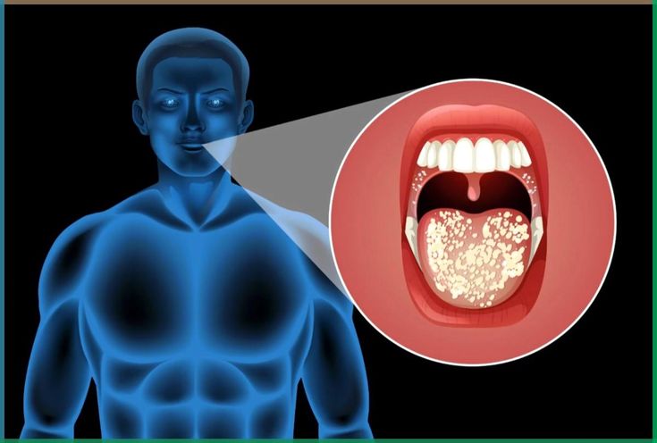 Oral Cancer Treatment