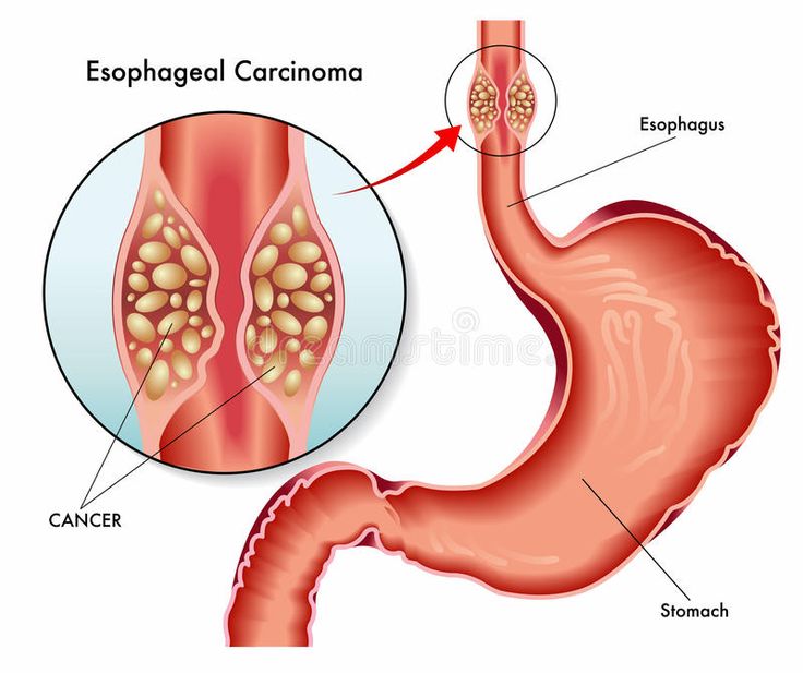 Esophageal Cancer Treatment