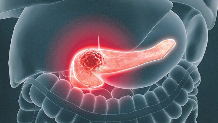Pancreatic Cancer Treatment