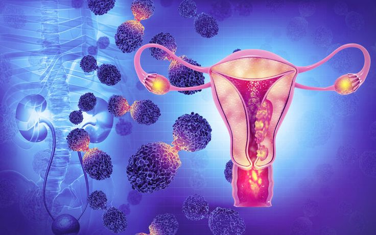 Gynecological Cancer Treatment