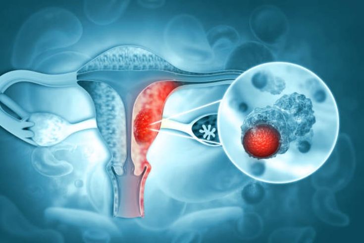 Cervical Cancer Treatment