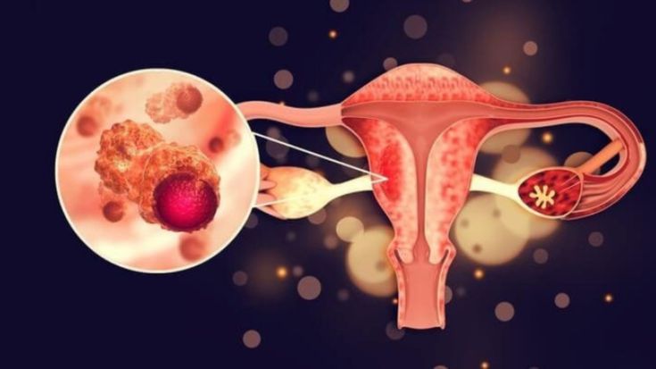 Ovarian Cancer Treatment