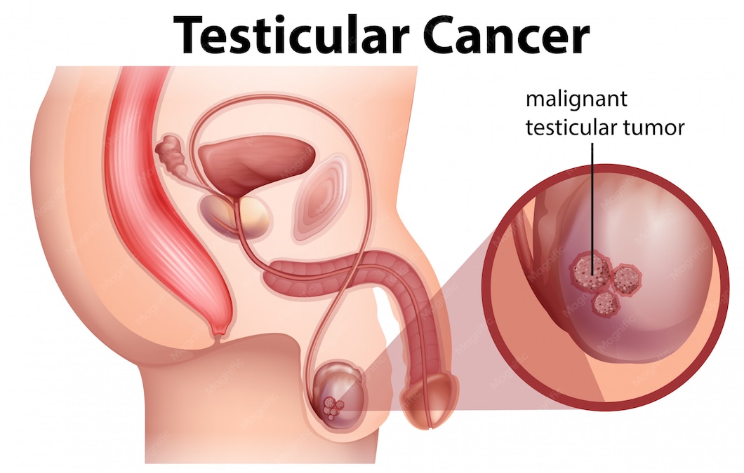 Penile Cancer Treatment