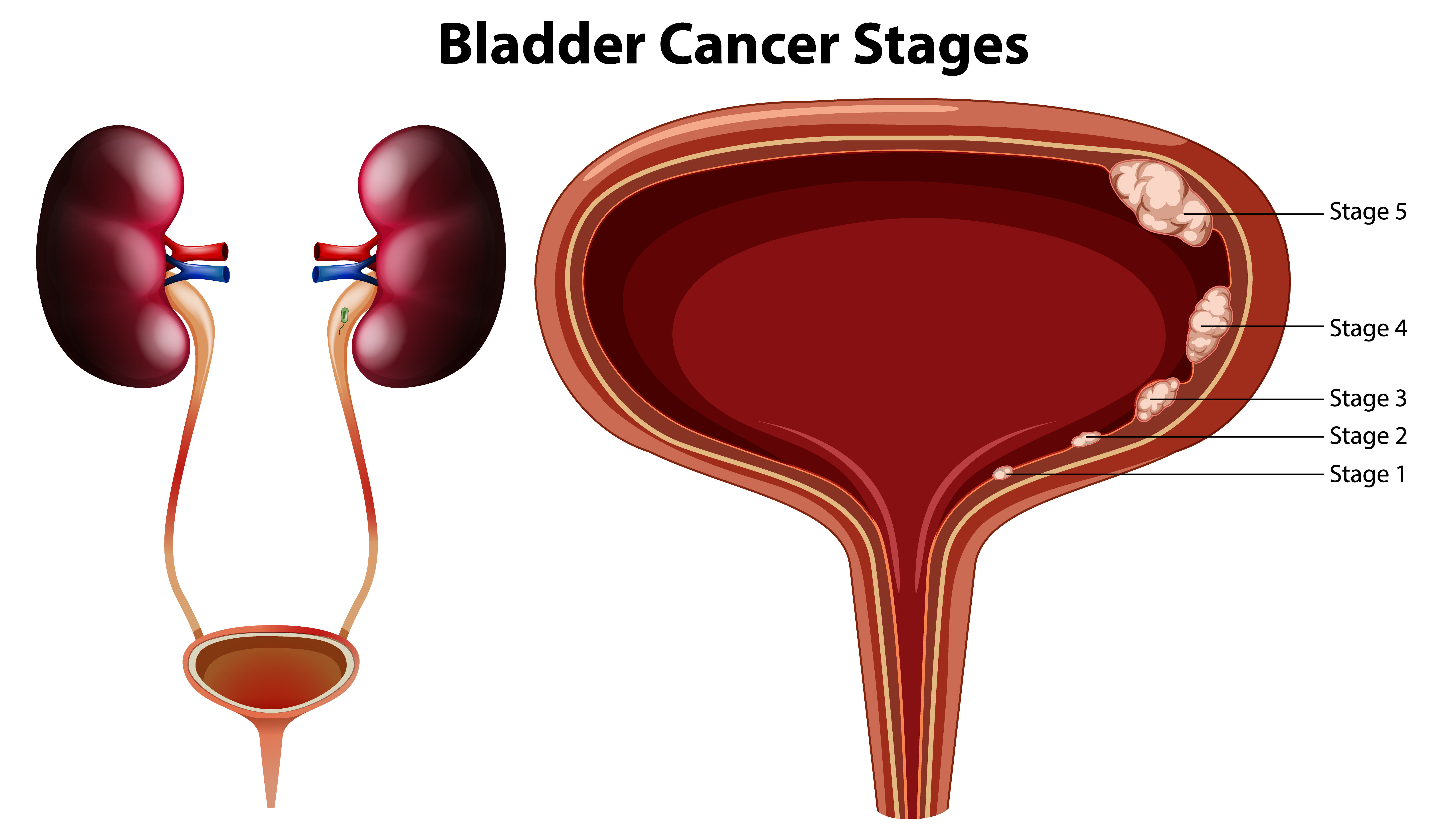 Bladder Cancer Treatment