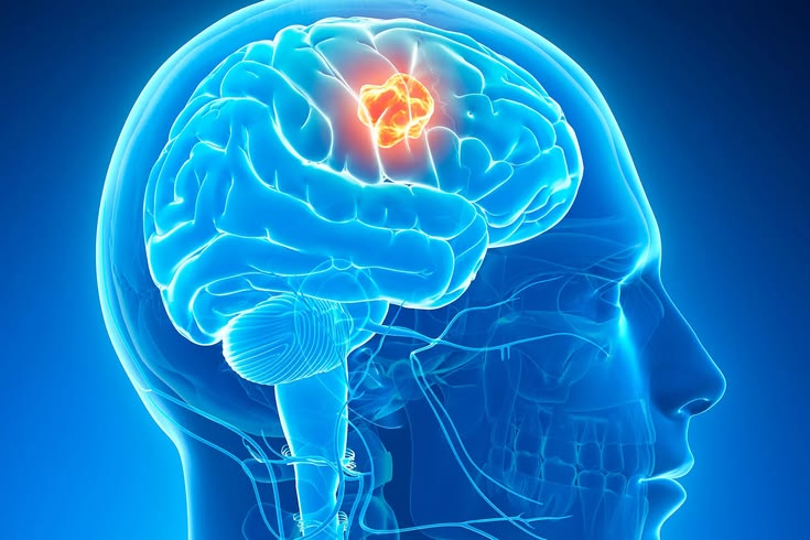 Brain Tumour Treatment